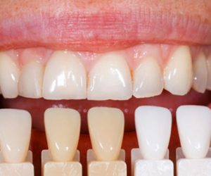 Dán sứ veneer để làm gì