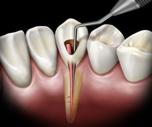 Quy trình điều trị nội nha - chữa tủy