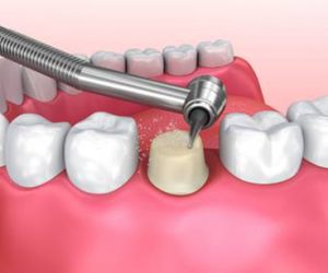 Quy trình bọc răng sứ