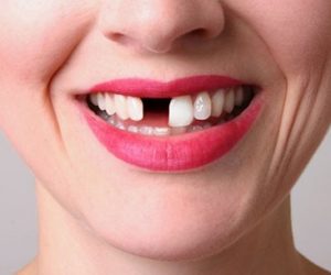 Mất răng có cần trồng lại răng không