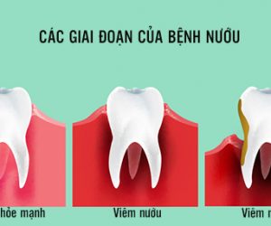 Các giai đoạn của bệnh nướu