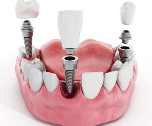Có nên trồng răng implant