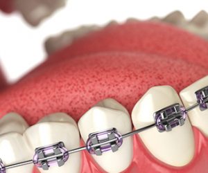 Quy trình các bước niềng răng