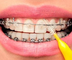 Chăm sóc răng niềng đúng cách