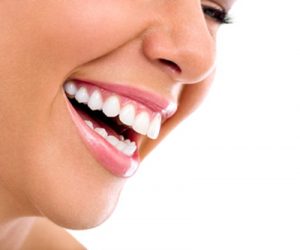 Tẩy trắng răng là gì?