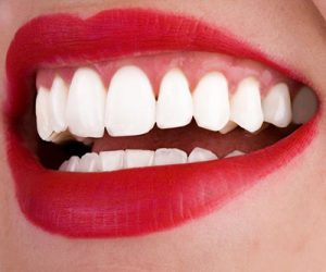 Các phương pháp tẩy trắng răng