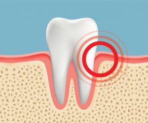 Tác hại bệnh nha chu