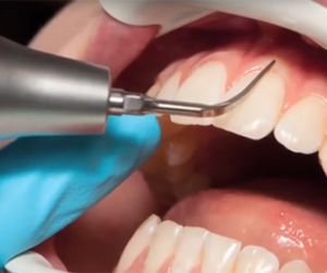 Cạo vôi răng công nghệ Thụy Sĩ tại Nha khoa No1