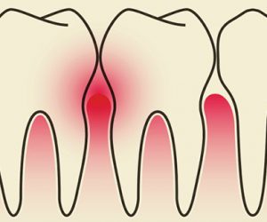 Viêm nướu là gì?