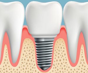 Trồng răng implant là gì