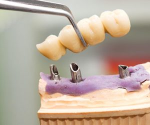 khi nào nên trồng răng implant