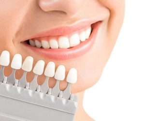 Quy trình dán răng sứ veneer