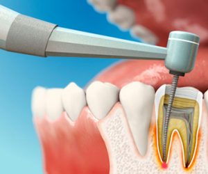 Chữa tủy răng là nỗ lực cứu giữ răng tự nhiên
