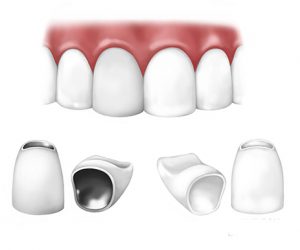 Bọc răng sứ giá bao nhiêu?
