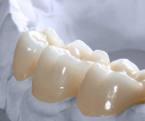 Có bao nhiêu loại răng sứ