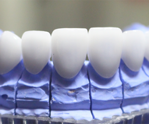 Bọc răng sứ thẩm mỹ