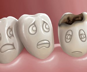 Sâu răng: nguyên nhân, triệu chứng, diễn biến, giải pháp và cách phòng ngừa